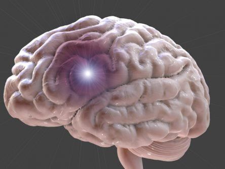 SFI research could predict strokes in younger people more accurately